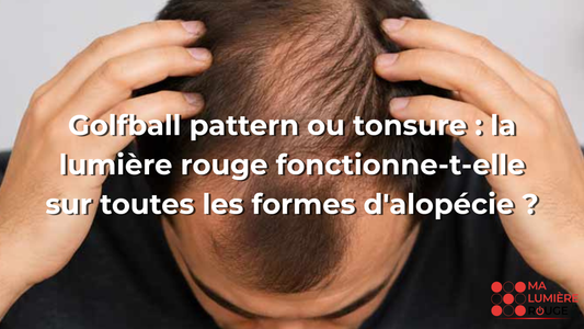 Golfball pattern ou tonsure : la lumière rouge fonctionne-t-elle sur toutes les formes d'alopécie ?